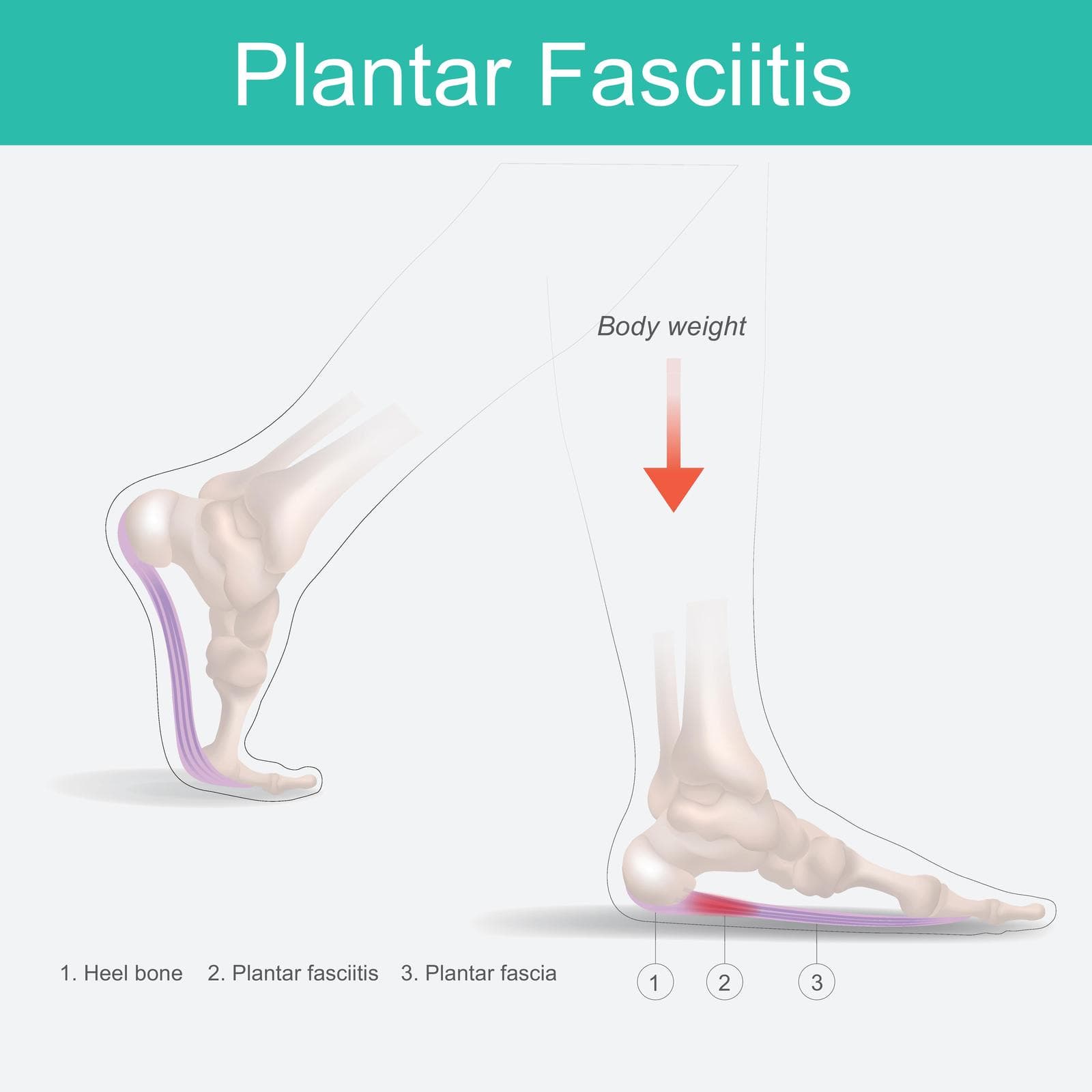 The Role of Stretching and Exercise in Treating Plantar Fasciitis