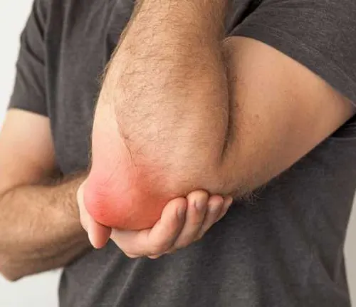 Bursitis