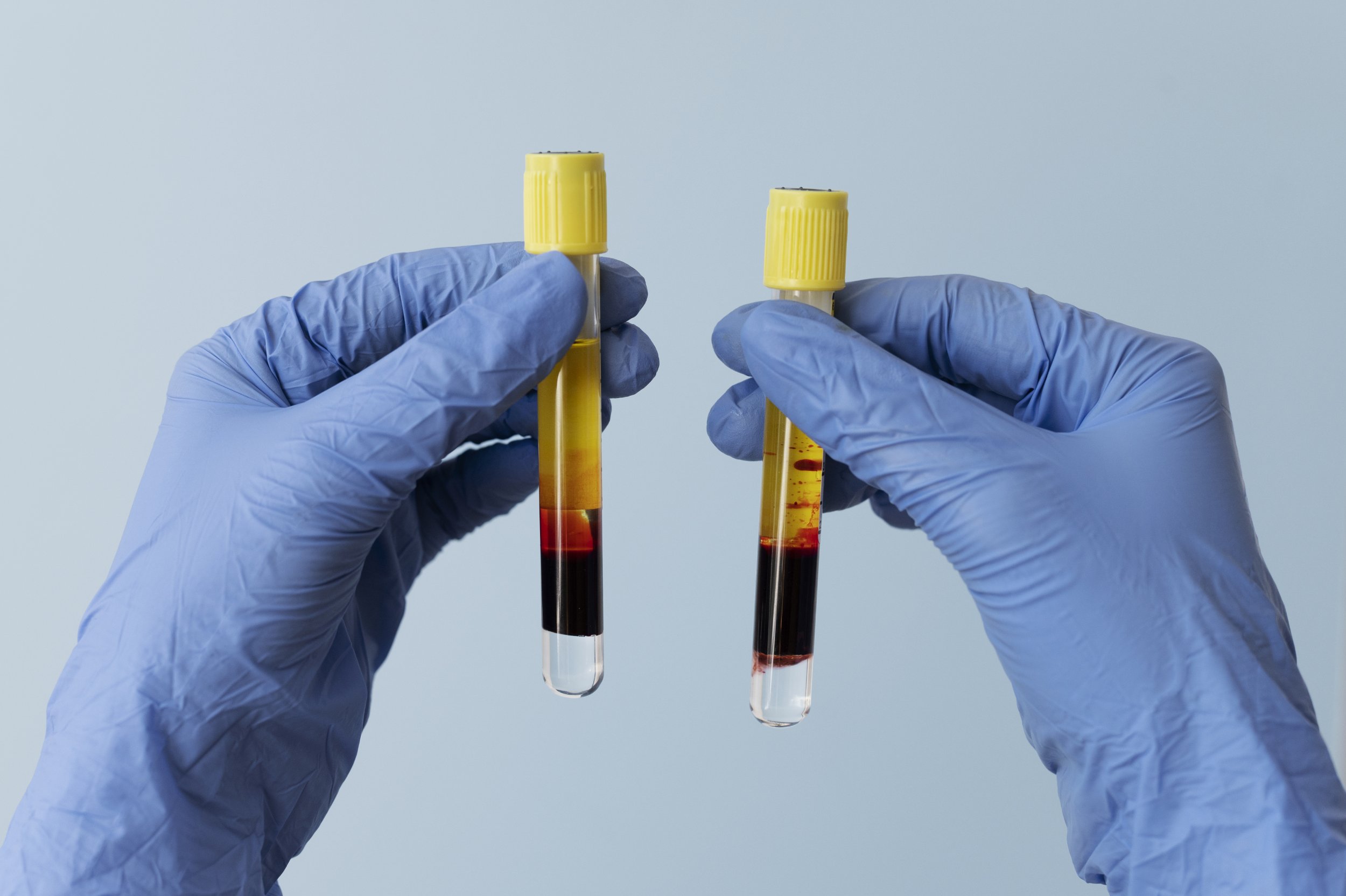 hands-with-gloves-holding-vials-prp